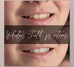 Download Sweet Soul Studio – Whiten Teeth Action